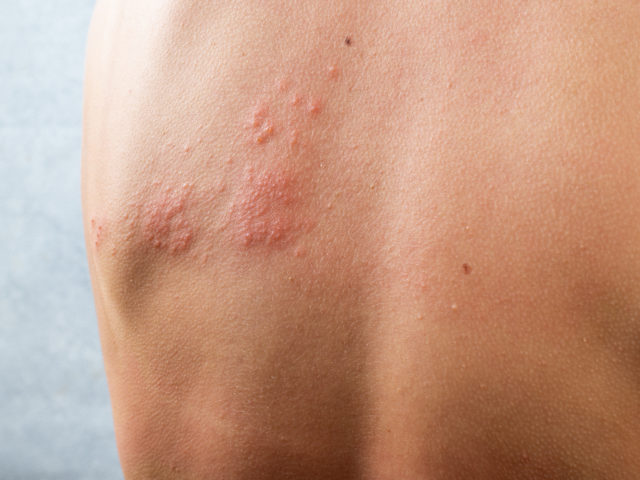 Alergia na salicylany: objawy i leczenie