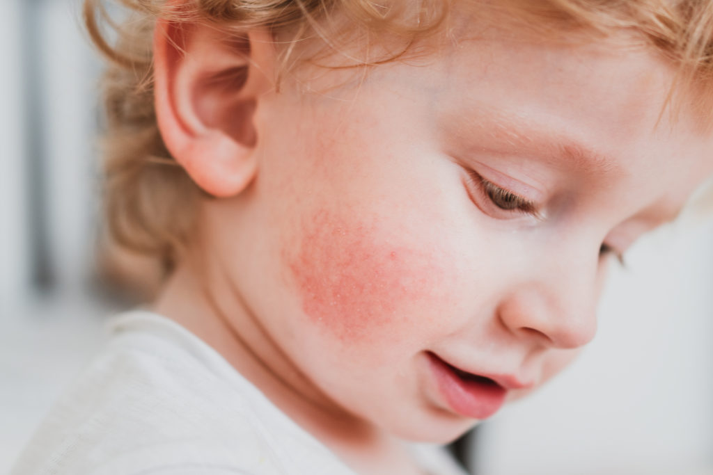 Alergia Pokarmowa U Dziecka Jakie Są Objawy I Jak Leczyć 9061