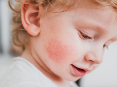 Alergia pokarmowa u dziecka