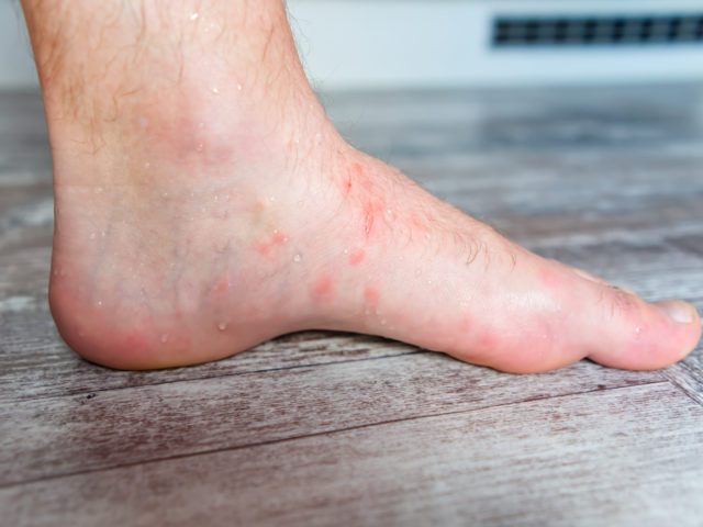 Krosty na nogach – jak wyleczyć pryszcze na nogach?