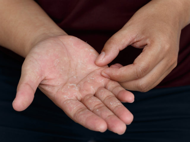 Łuszczyca dłoni – przyczyny, objawy i leczenie