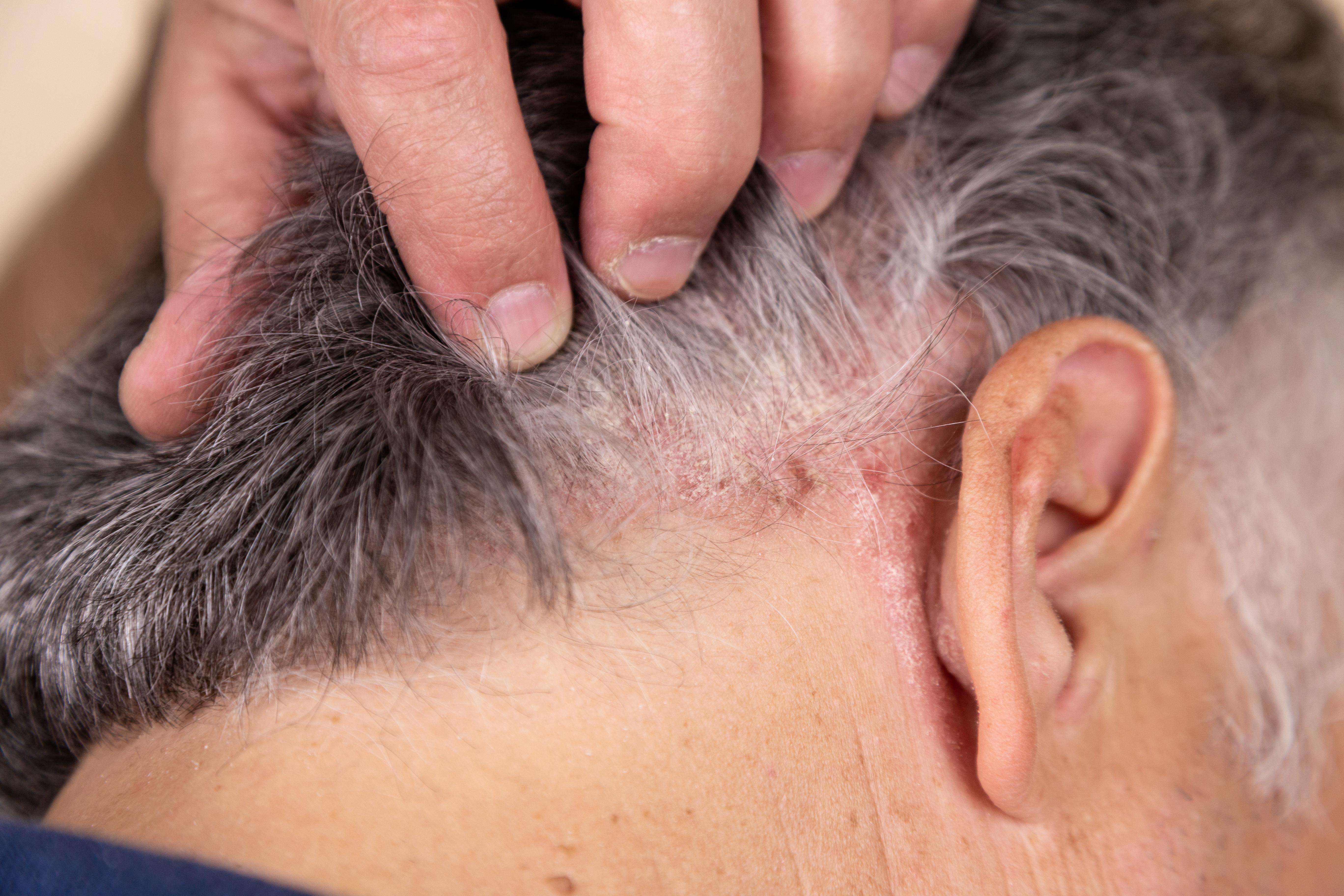 Łuszczyca głowy – przyczyny, objawy i leczenie