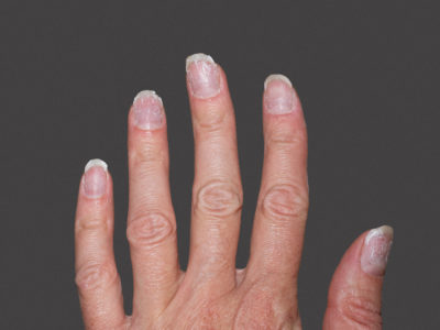 Łuszczyca paznokci