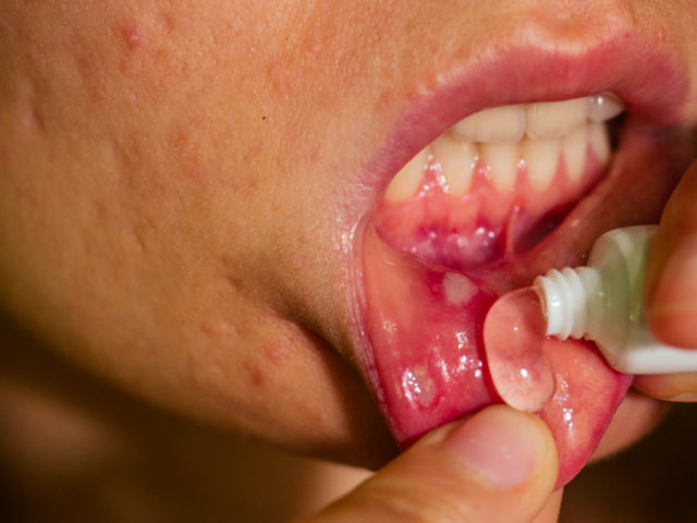 Opryszczkowe zapalenie jamy ustnej – jak się objawia i jak leczyć?
