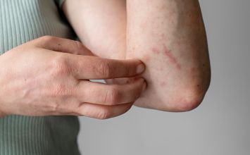 Jak wyglądają ugryzienia roztoczy? Jak przebiega leczenie?
