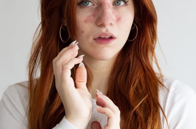 Atopowe zapalenie skóry powiek - przyczyny, objawy, leczenie