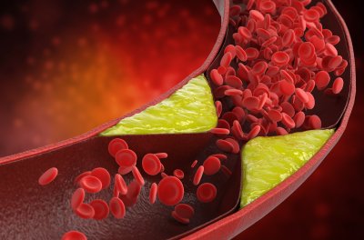 Alkohol a cholesterol: jak wpływa na poziom cholesterolu?