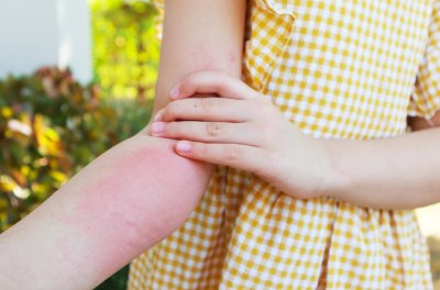 Atopowe zapalenie skóry u dzieci: jak ją rozpoznać?
