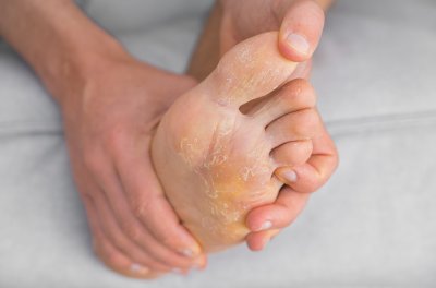 Egzema na nogach - przyczyny i leczenie