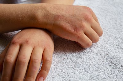Jak wygląda egzema na dłoniach i jak ją leczyć?